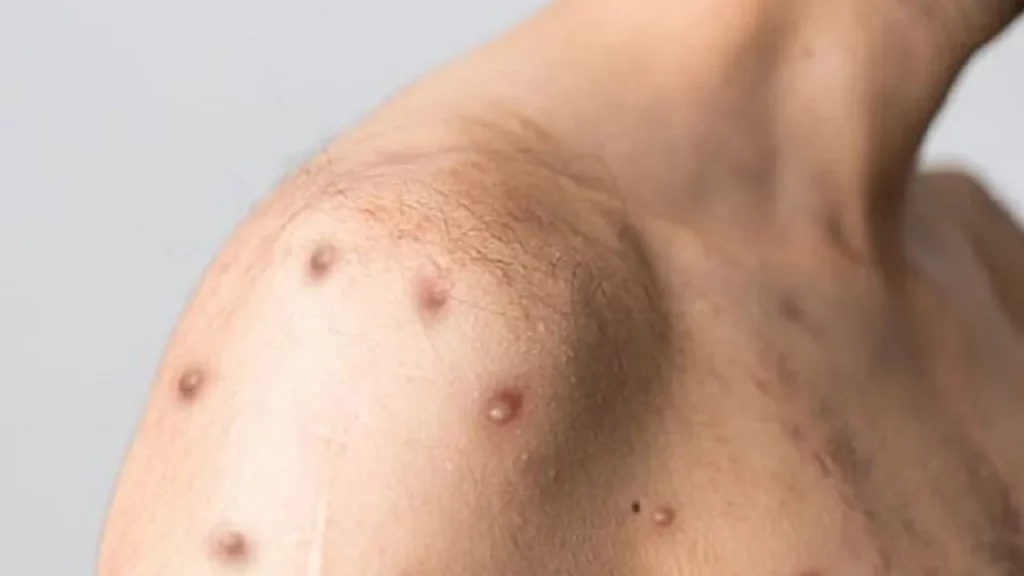 Các triệu chứng thường gặp khi hệ miễn dịch suy yếu
