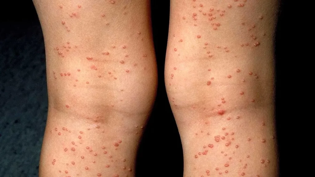 Cuộc sống của người nhiễm HIV trong quá khứ và hiện tại: Một sự thay đổi lớn