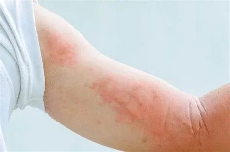 Giai đoạn 1: Nhiễm trùng cấp tính (Acute HIV Infection)