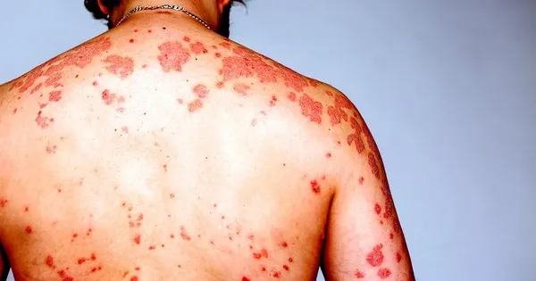 Giai đoạn đầu của HIV là gì?