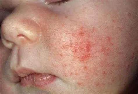 HIV ở trẻ sơ sinh là gì?