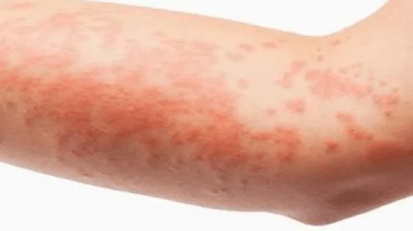 Khi nào cần đi xét nghiệm HIV?