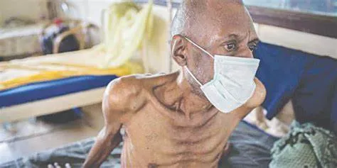 Tại sao người nhiễm HIV dễ mắc các bệnh đồng nhiễm?