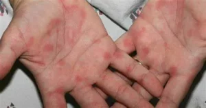 dấu hiệu nhận biết nhiễm HIV