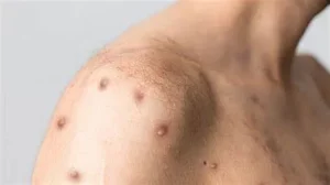 triệu chứng HIV giai đoạn đầu